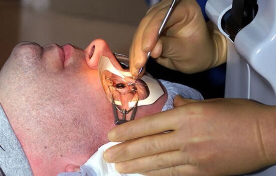 Skleroplastik fir Myopie fir Visioun ze stabiliséieren