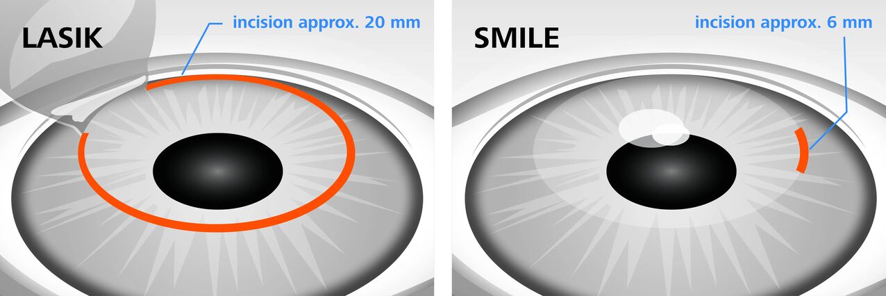 Verglach vu Laser Visioun Korrektur Methoden LASIK a SMILE